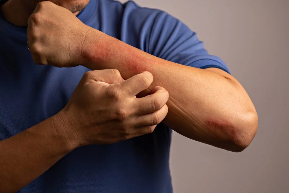 Home Remedies for Heat Rash